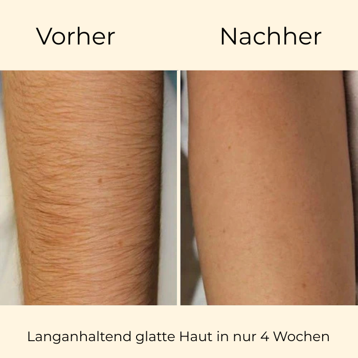 IHF AetherGlow™ IPL Pro